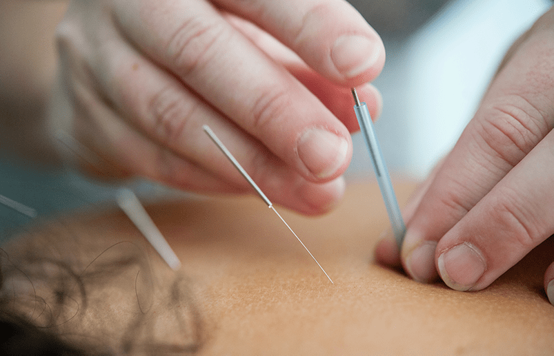 A person receiving acupuncture treatment